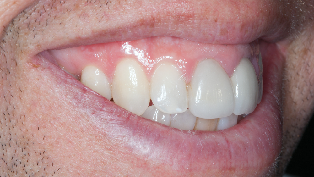 Figures 4c: The over-contoured existing all-ceramic crowns are exhibited during examination of the smile progression. The patient’s lip movement presents an esthetic challenge due to the high smile line.