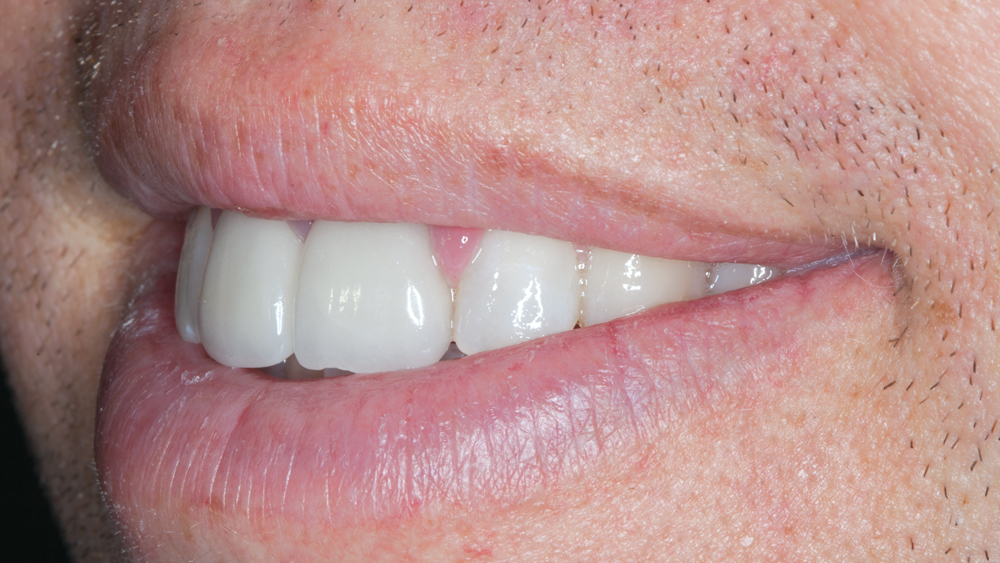 Figures 4d: The over-contoured existing all-ceramic crowns are exhibited during examination of the smile progression. The patient’s lip movement presents an esthetic challenge due to the high smile line.