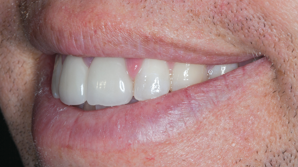 Figures 4e: The over-contoured existing all-ceramic crowns are exhibited during examination of the smile progression. The patient’s lip movement presents an esthetic challenge due to the high smile line.