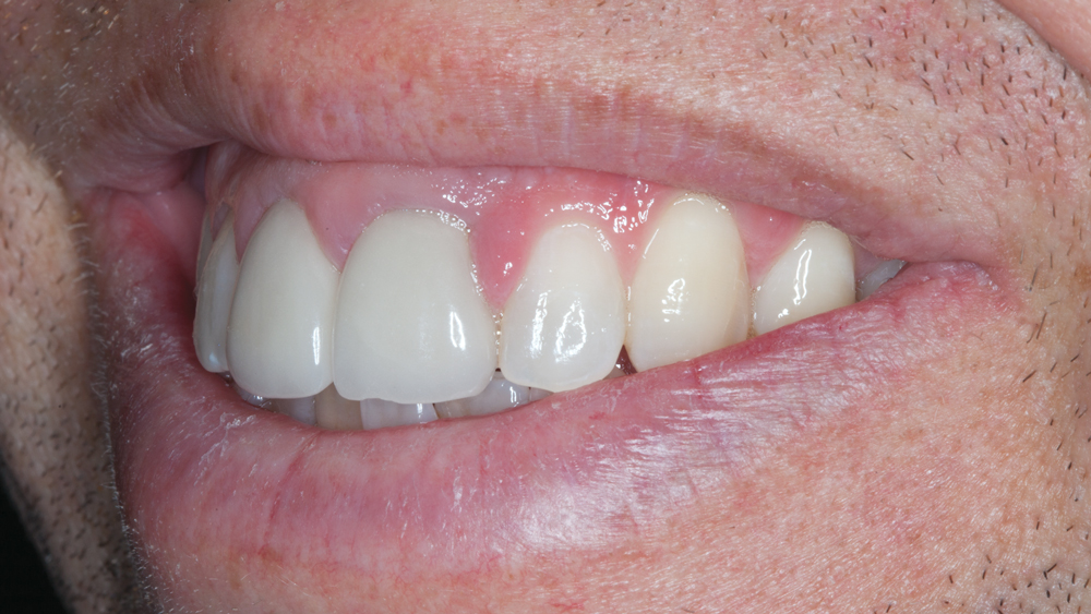 Figures 4f: The over-contoured existing all-ceramic crowns are exhibited during examination of the smile progression. The patient’s lip movement presents an esthetic challenge due to the high smile line.