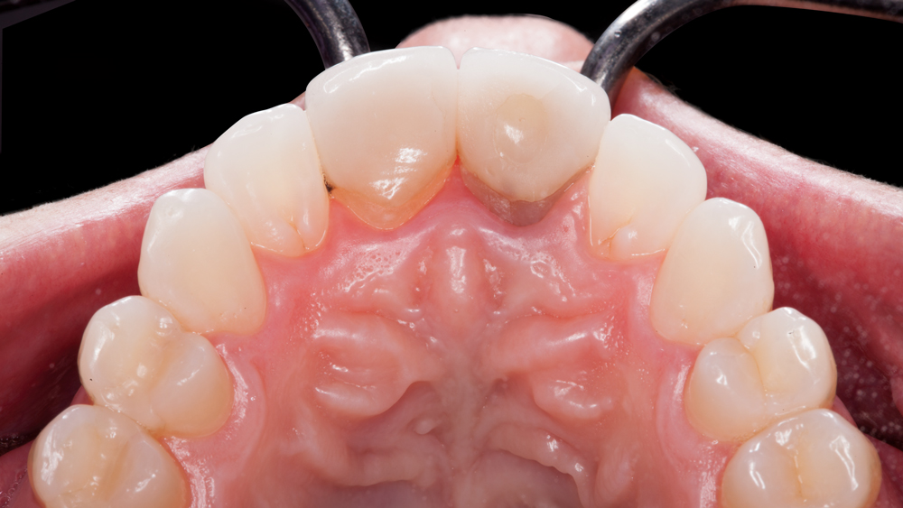 tooth with preoperative vinyl polysiloxane (VPS) impressions are made for the BioTemps CAD Provisionals.