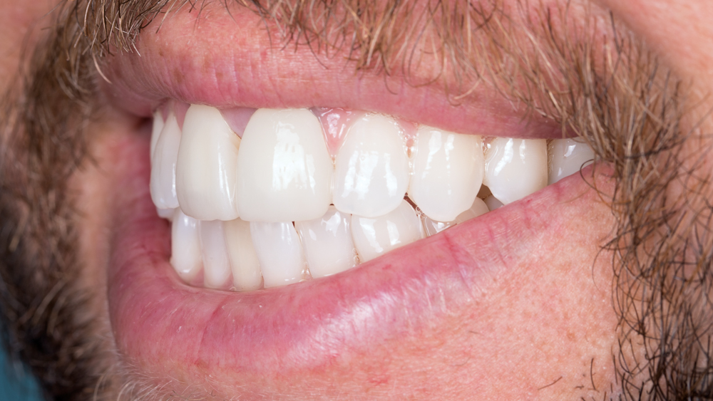 Figures 18b: After one week, the patient returns for a follow-up appointment. At this stage, photos are taken to highlight the appearance of the BioTemps CAD Provisionals in place. Note the gingival health with the BioTemps in place after a single week of healing.