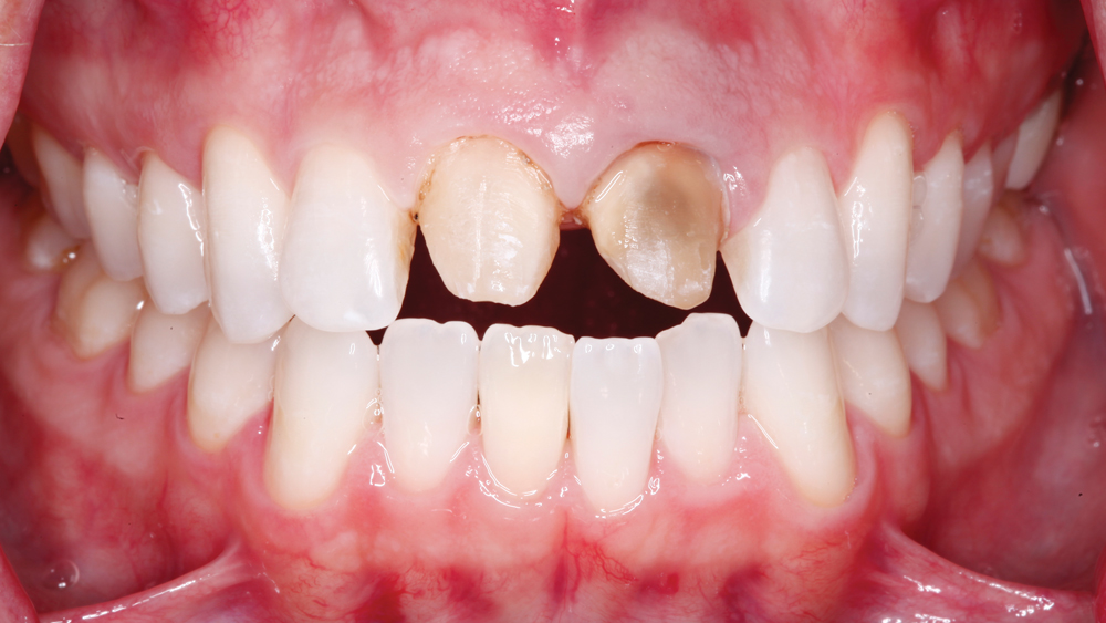 Figure 13: With the BioTemps fully fabricated, the patient returns for a second visit. The area is anesthetized and the existing all-ceramic crowns are removed. The previous dentist was overly conservative with the initial preparation, resulting in bulky final restorations. Many clinicians practice very conservative, well-intentioned dentistry; however, vetted restorative materials feature specific reduction guidelines that should be followed when possible to produce the best results.