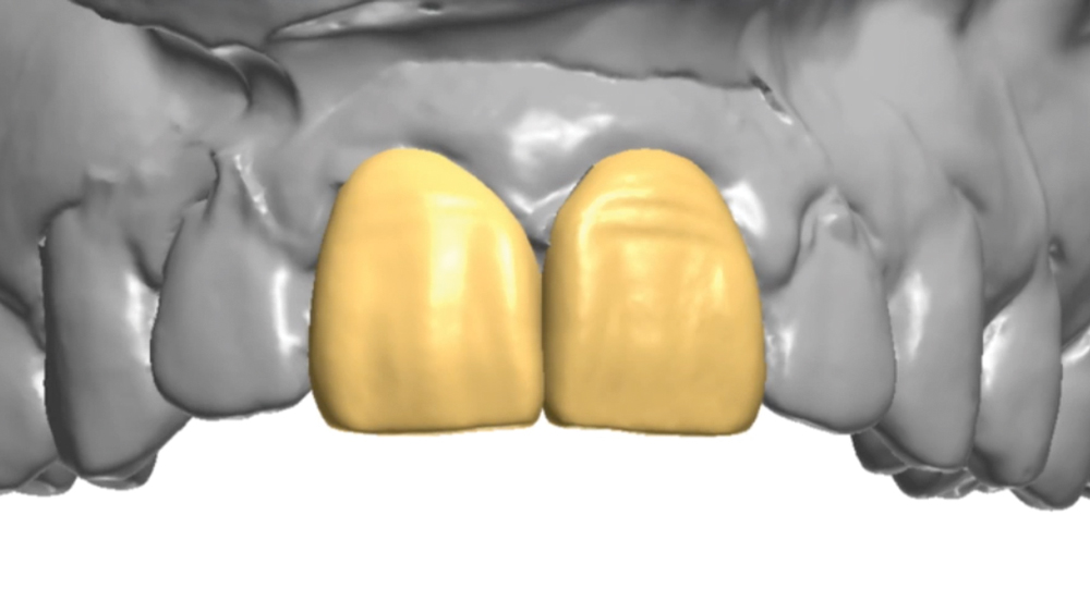Figure 9: Utilizing the software, the occlusal plane is marked. This informs the software how the data set should be positioned in the 3D space. Then, the technician will use the margins of the existing restorations as a rough guideline to place the new margins. The new margins are set similar to a crown preparation, except more coronally on the interproximal than they are on the facial and lingual. With the occlusal plane and margins set, the software generates BioTemps over the existing dentition. These new digital provisionals can be further contoured and enhanced as necessary by the technician.