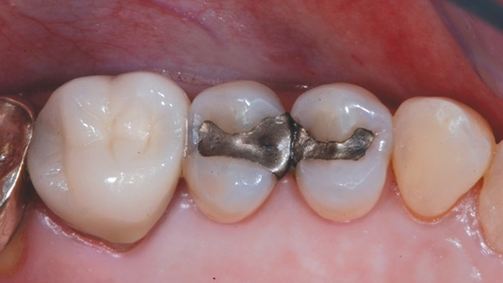 teeth with Obsidian® lithium silicate – Before