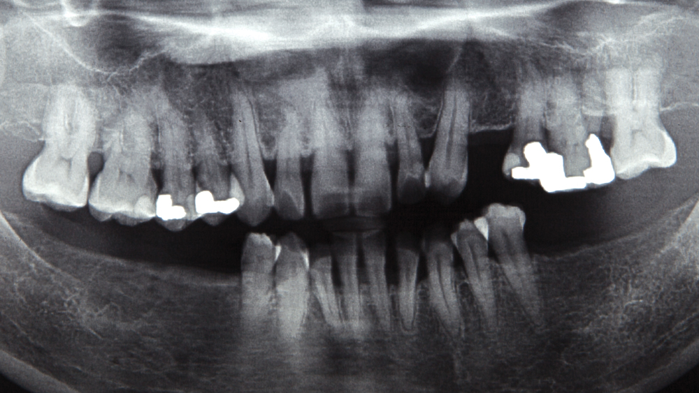 dental x-ray of smoker who lost their teeth