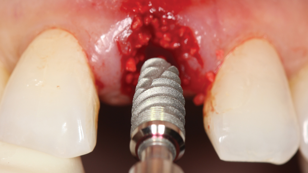 Surgical placement of a dental implant
