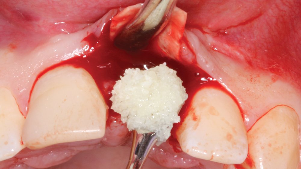 A bone replacement graft for ridge preservation