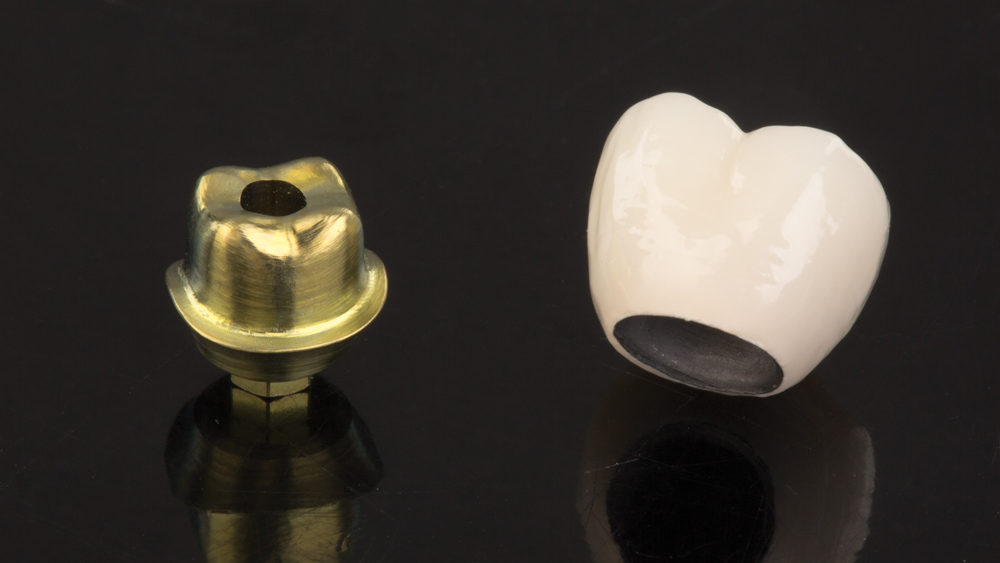 An abutment-supported porcelain fused to metal crown