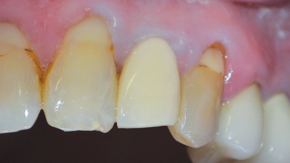 Case Study Immediate Placement of a NarrowDiameter Implant Into an