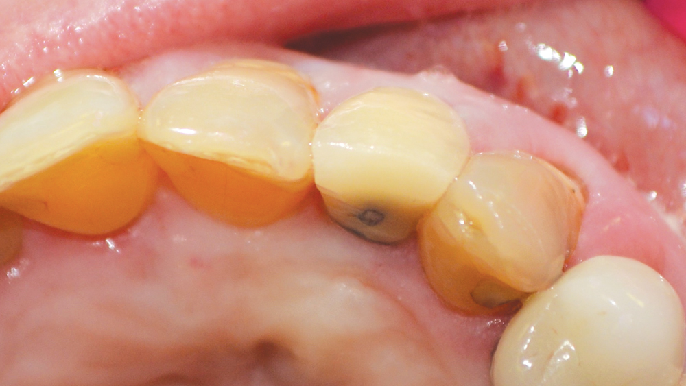 Case Study Immediate Placement of a NarrowDiameter Implant Into an