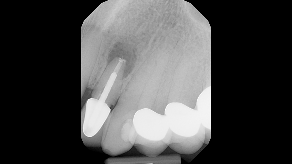 Case Study Immediate Placement of a NarrowDiameter Implant Into an