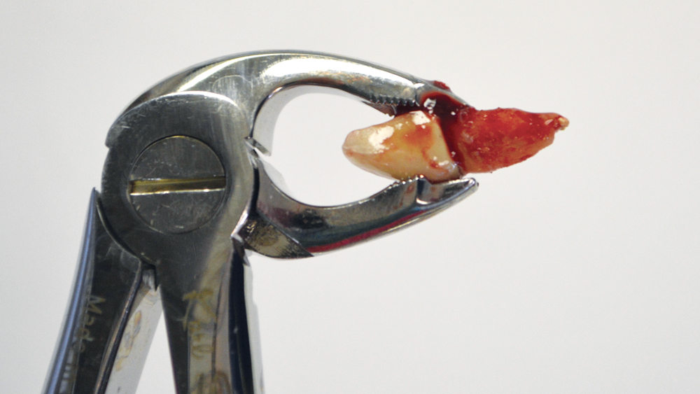 Case Study Immediate Placement of a NarrowDiameter Implant Into an