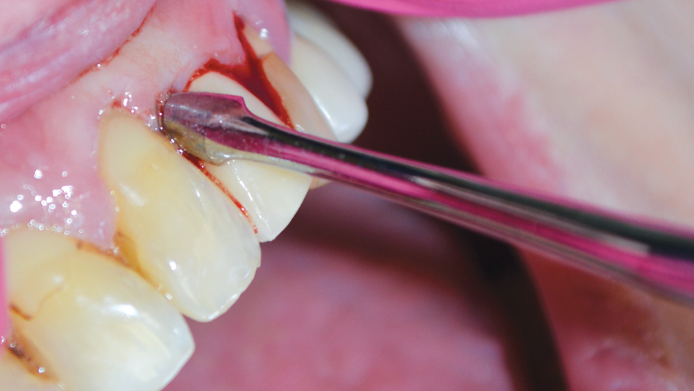 Case Study Immediate Placement of a NarrowDiameter Implant Into an