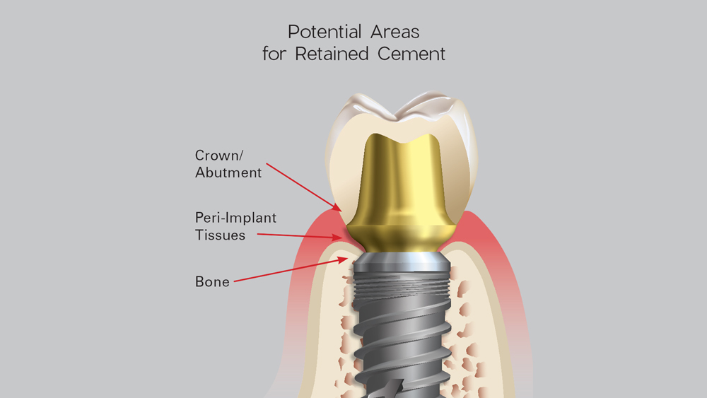 Potential Areas for Retained Cement 