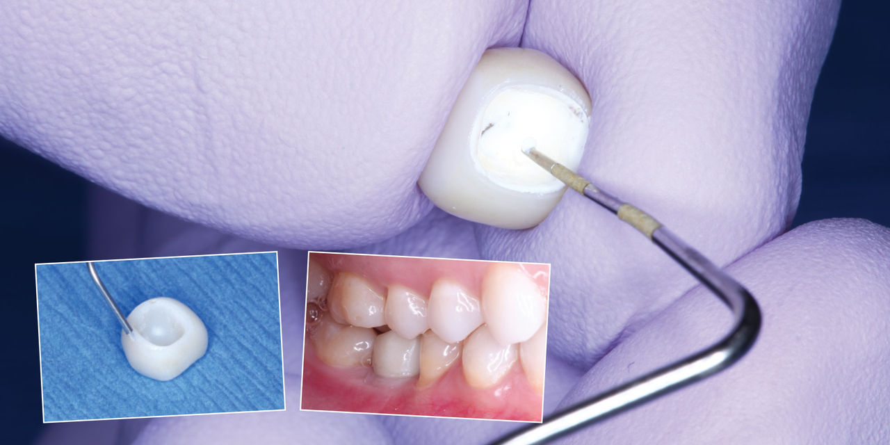 Images of teeth implant restoration