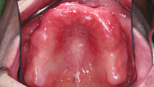 How to Fine-Tune Form and Function During Complete Denture Fabrication