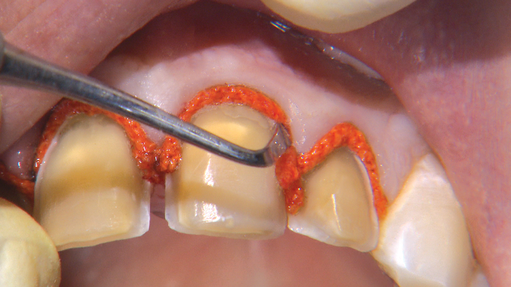 'Chairside Live' Case of the Week Replacing Worn Direct Composite