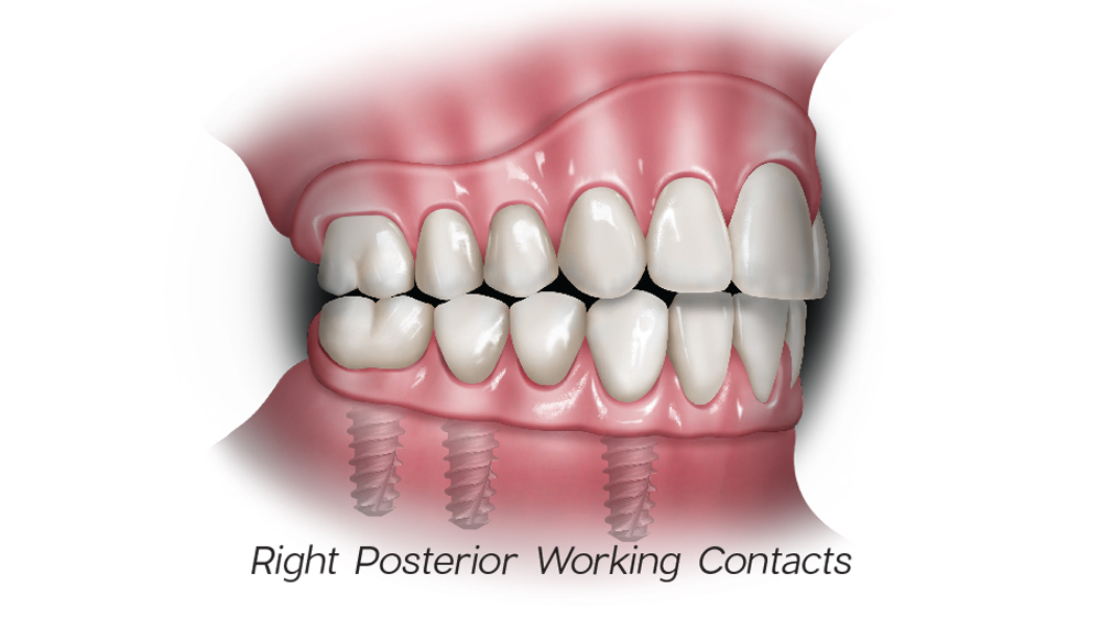 1c - Right Posterior Working Contacts