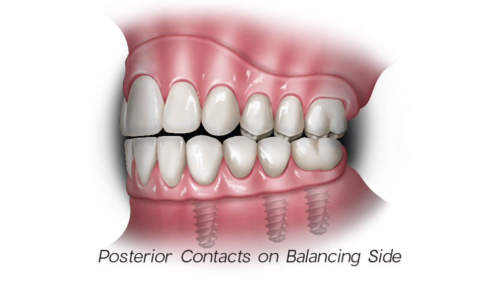 1d - Posterior Contacts on Balancing Side