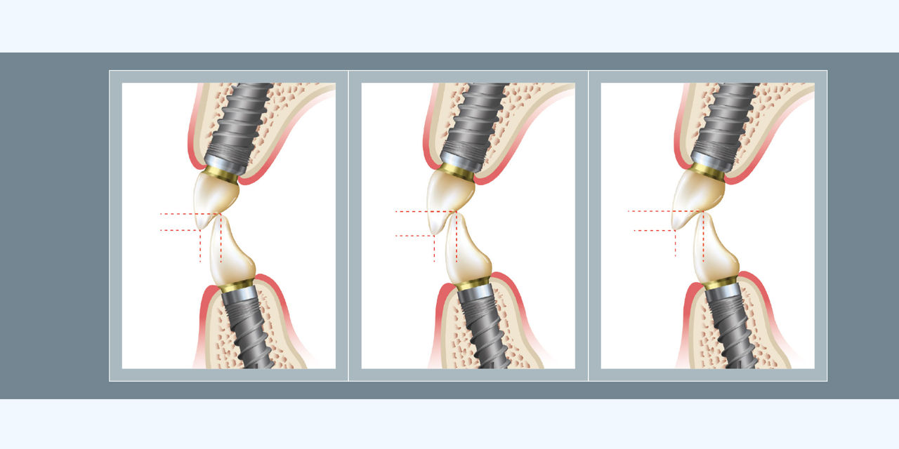 Principles of Implant Occlusion: Part 3 – Recommendations for Fixed Full-Arch Implant Prostheses Hero Image