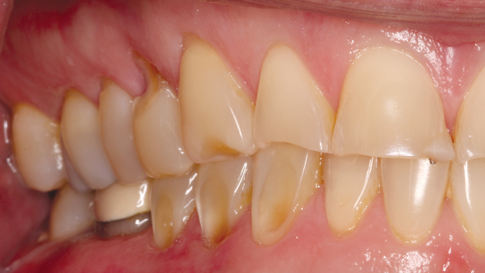 Bruixir Express Number Full-Mouth Rehabilitation with BruxZir® Full-Strength and BruxZir Anterior