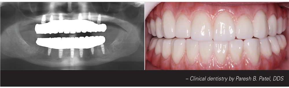 The BruxZir Full-Arch Implant Prosthesis in mouth and in x-ray