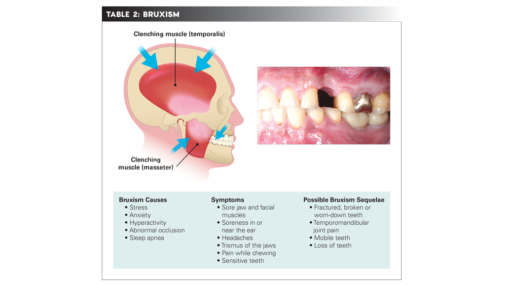 Chart diagraming what happens during a bruxism