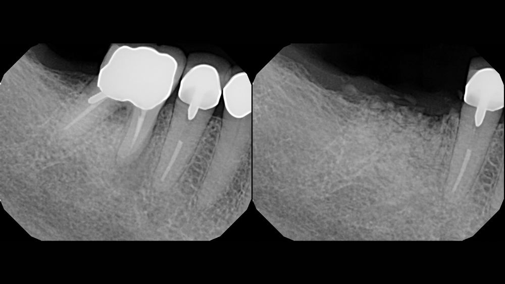 X-ray of a patient's fractured tooth in need of restoration