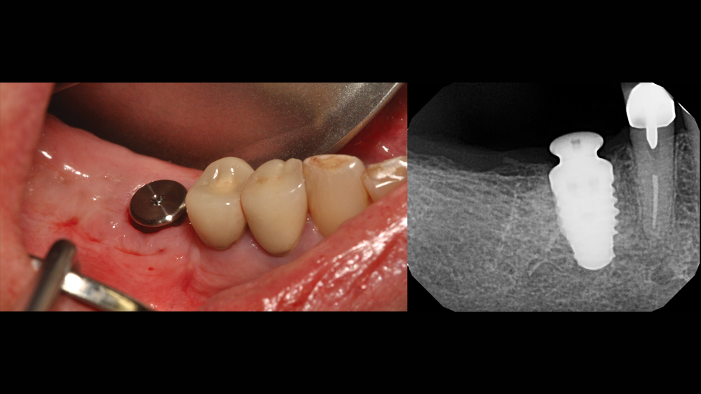 Image of Hahn Tapered Implant placed in patient's mouth with an x-ray of the placed implant