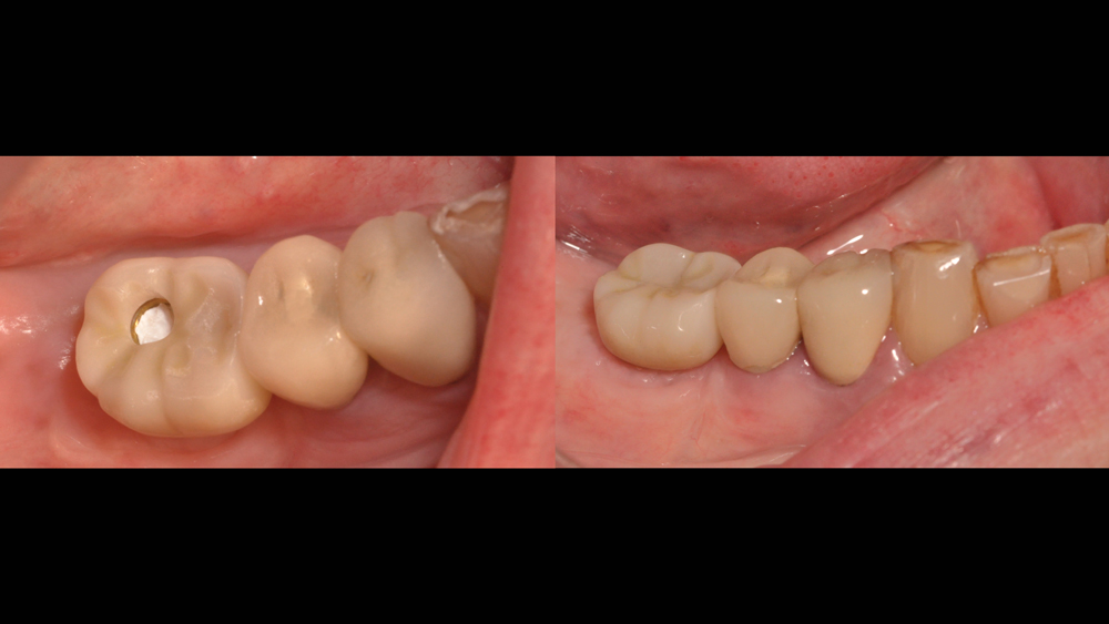 BruxZir Full-Strength Solid Zirconia screw-retained crown installed in patient's mouth