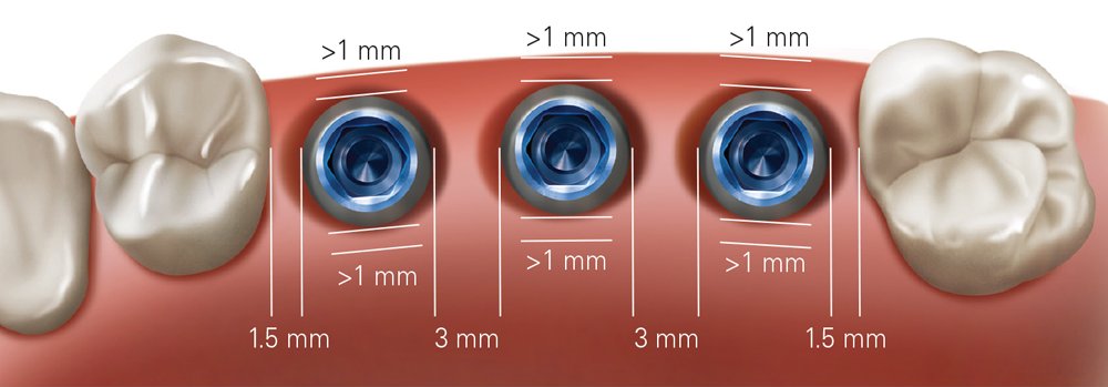 Interarch Distance Measurement Implant Spacing and Selection in the Posterior