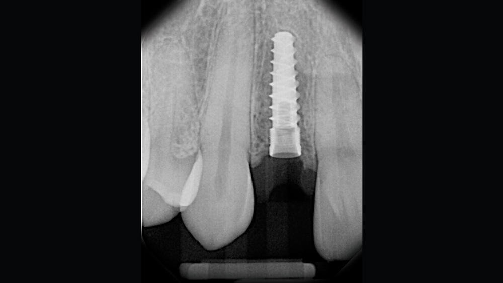 Radiographic view of implant