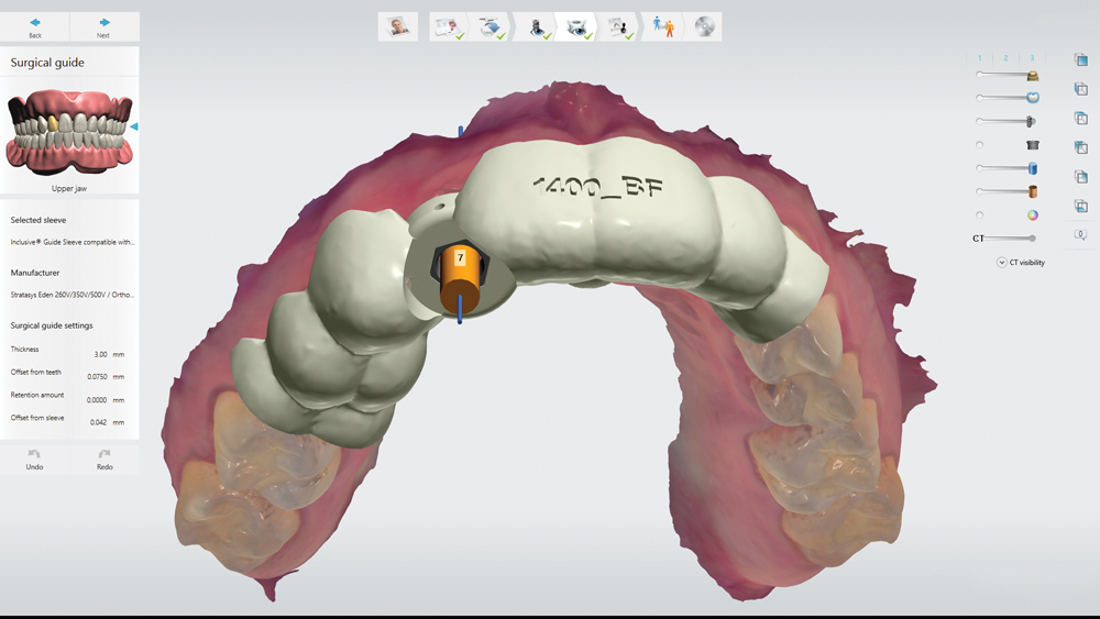 DTP team created the surgical guide design to precisely control the implant position at a distance of 2 mm from the neighboring teeth and 2.5 mm below the adjacent CEJ
