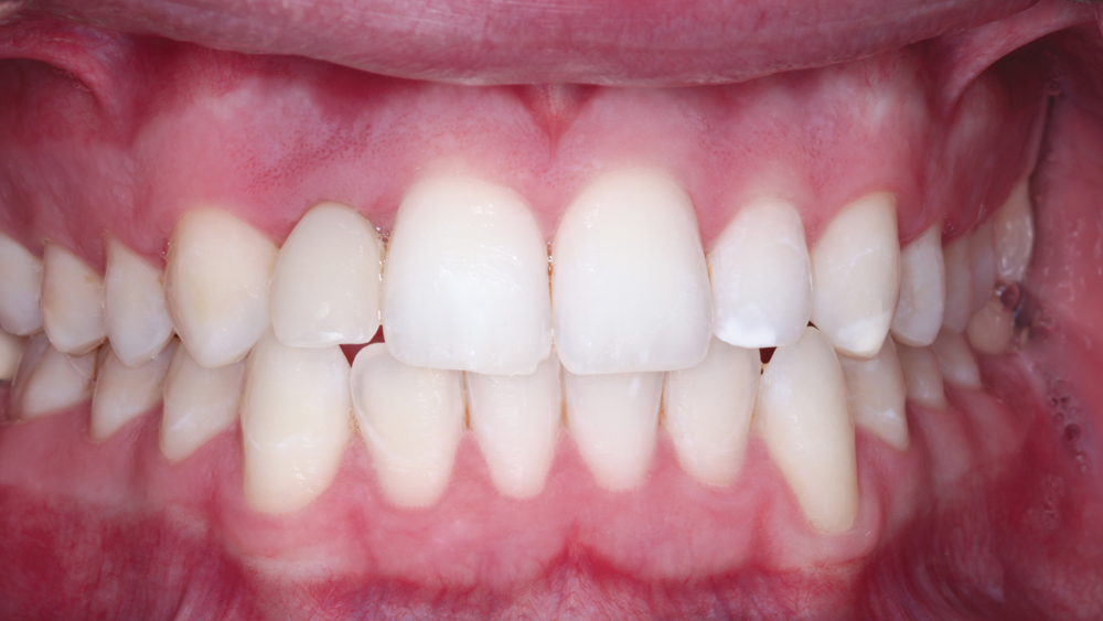 Patient's front teeth view one month later