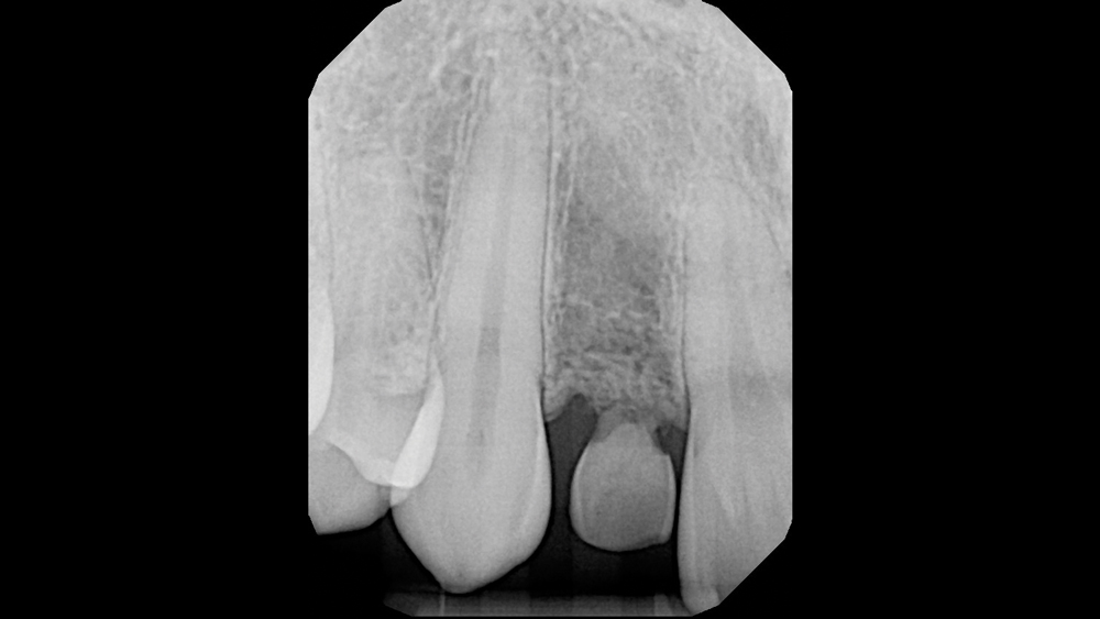 Radiographic view of the retained primary tooth