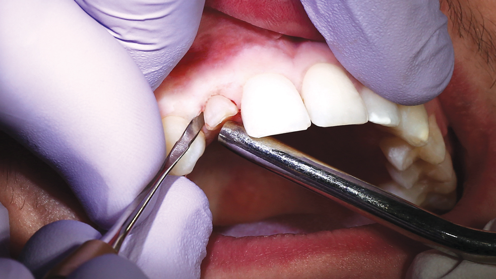 Image of the deciduous tooth being elevated using periosteal elevators