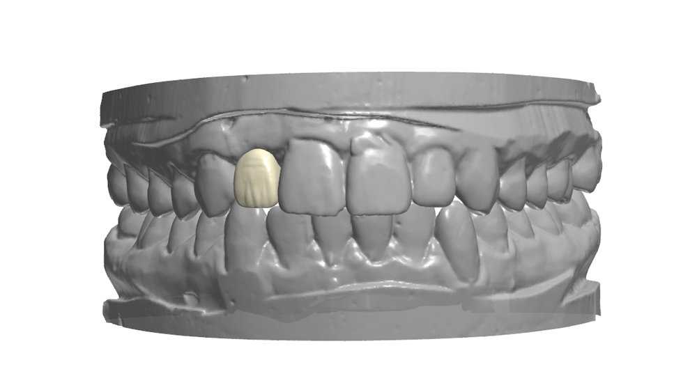 The final crown was designed using dental CAD software to mimic the contours of the contralateral tooth