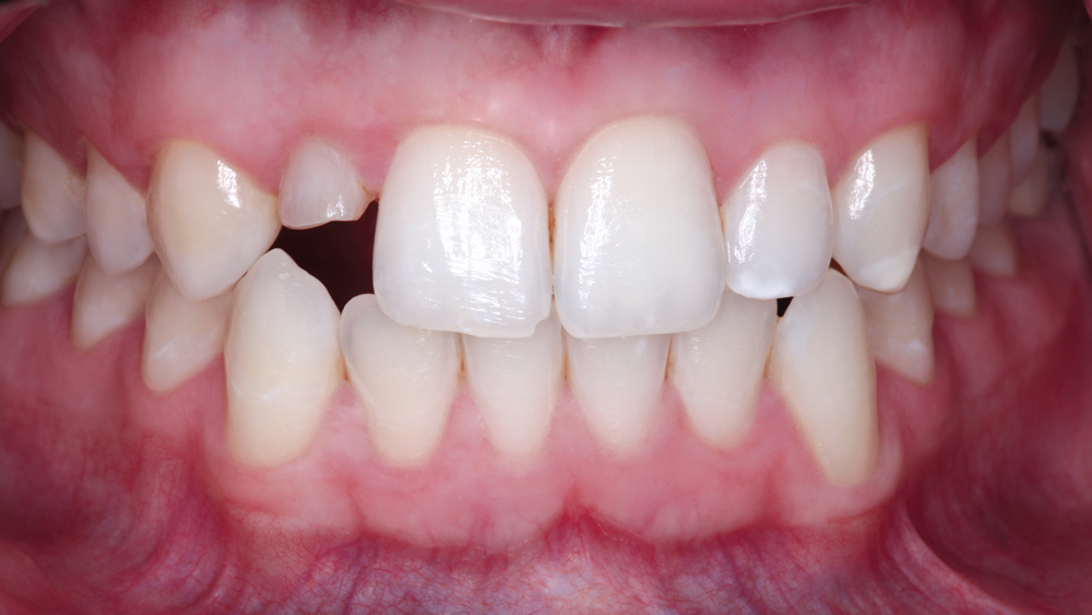 The patient sought a long-term solution for a retained primary tooth #D that was causing him significant esthetic concerns