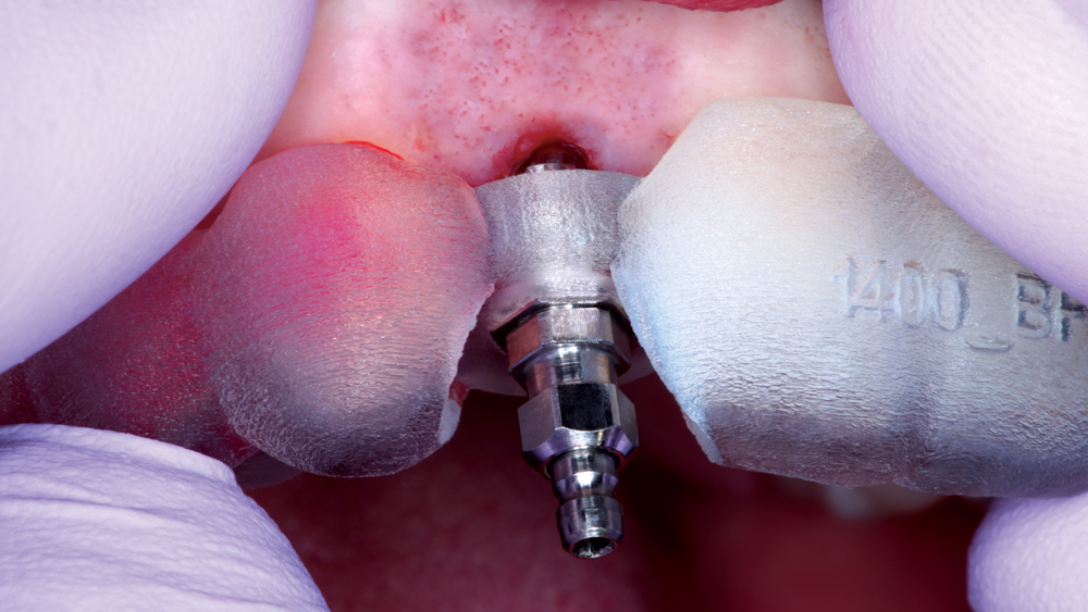 BioTemps screw-retained crown is properly fit and aligned