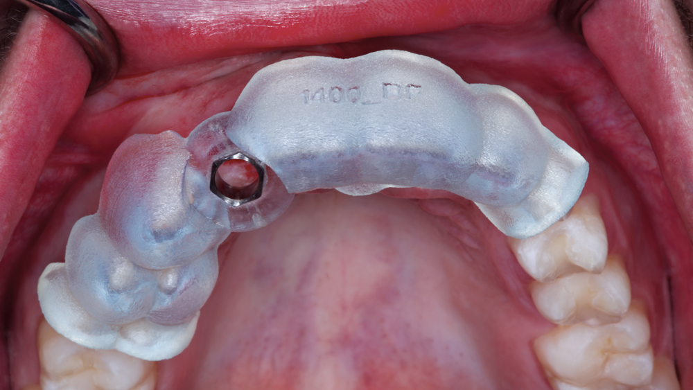 A surgical guide is placed on the extracted tooth location for precision