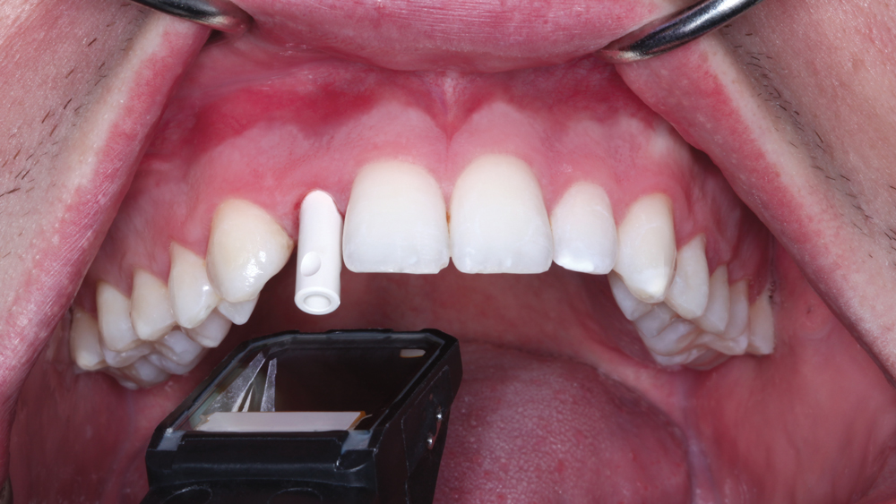 Patient's tooth after four months of healing and an Inclusive Scanning Abutment was connected to the implant