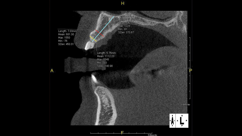 CBCT analysis confirmed adequate vertical and horizontal bone volume for a dental implant immediately following extraction
