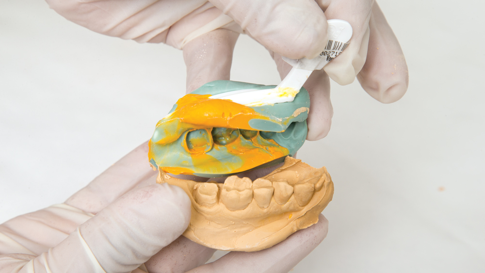 Dental impression aligning to stone model