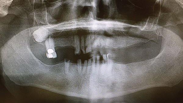 Extraction with Immediate Implant Placement in Full-Arch Indications