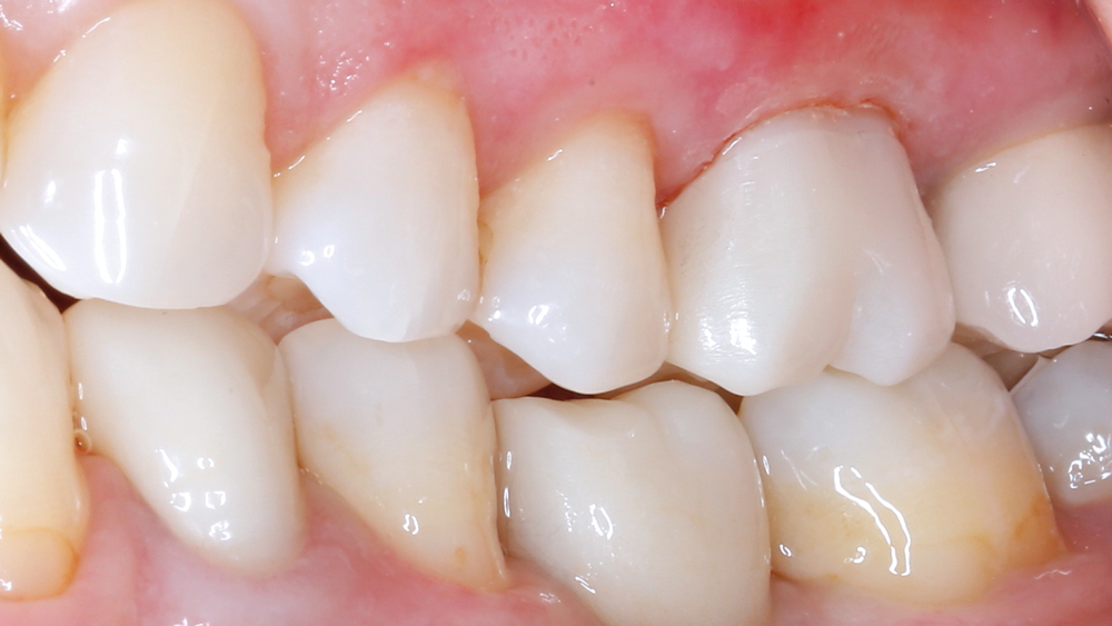 View of teeth restored (side-view)