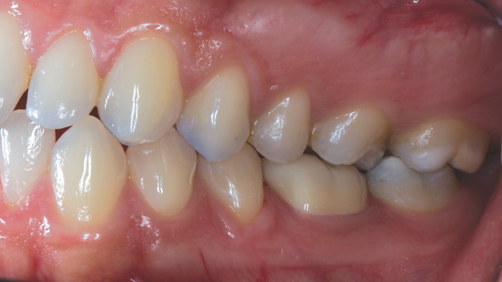 BruxZir® Full-Strength Solid Zirconia used on teeth (side view)