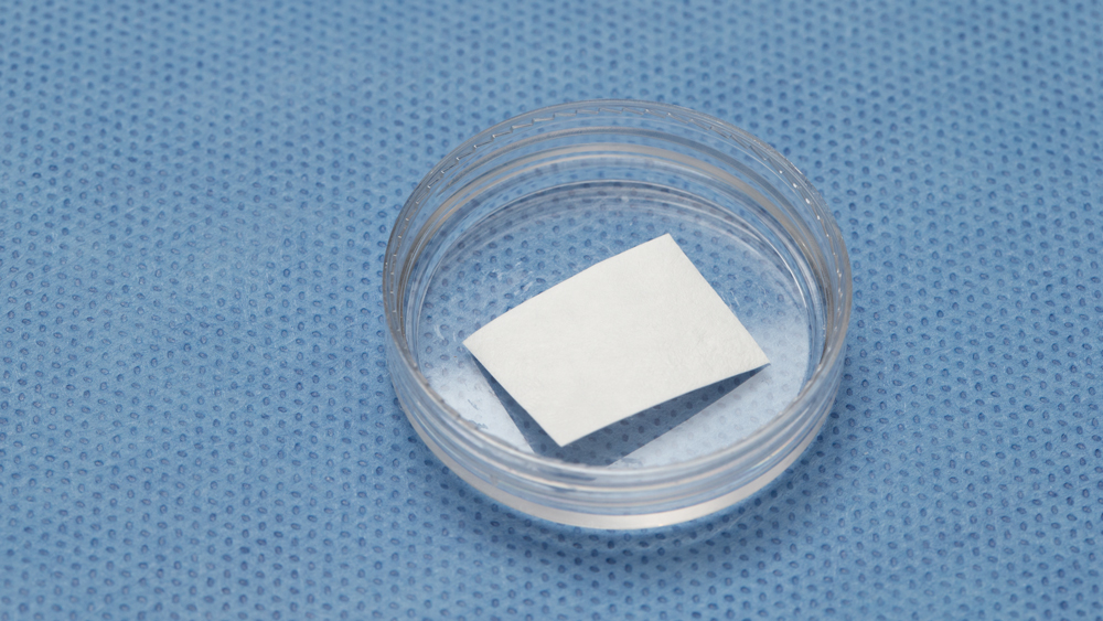 The Use of Barrier Membranes in Implant Dentistry