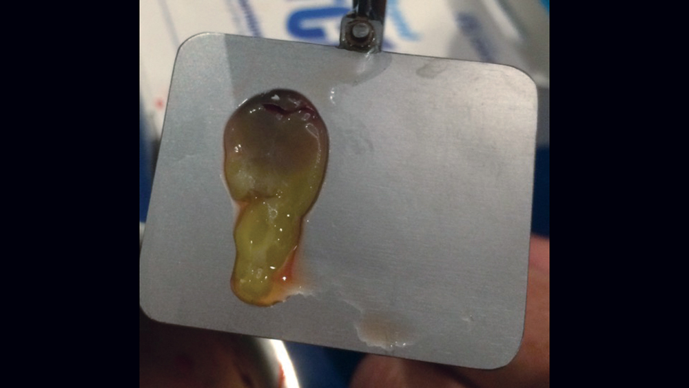 The Use of Barrier Membranes in Implant Dentistry