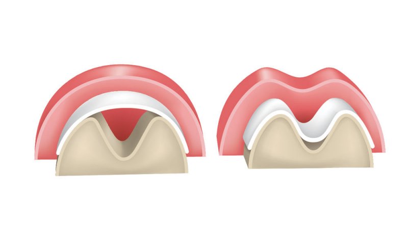 thumbnail image 2 of DSI Titanium Dental Implant Barrier Membrane, 44x44mm X 0.1mm, 1.4mm Pores, SDP-T44-044 2 of 5
